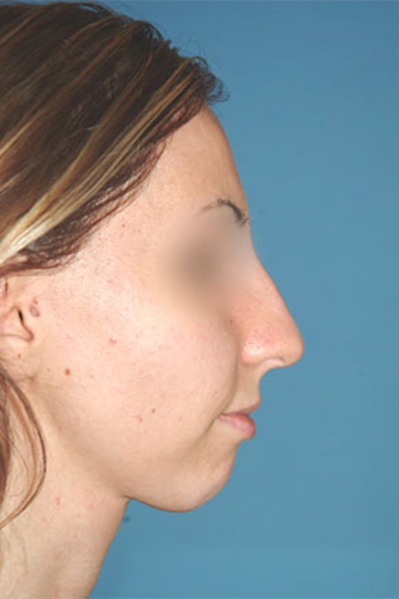 Rhinoplasty Before & After Gallery - Patient 810232 - Image 1