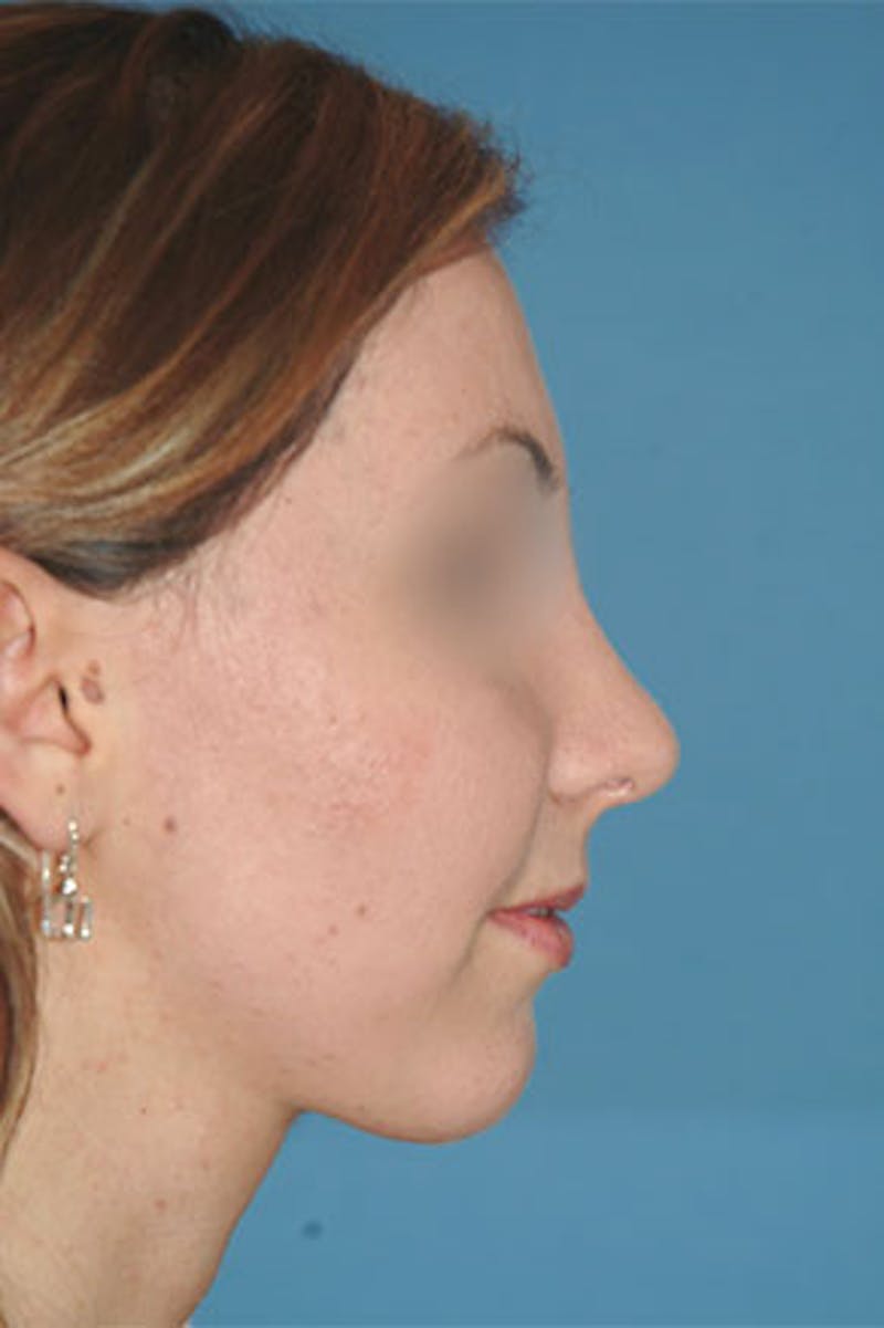 Rhinoplasty Before & After Gallery - Patient 810232 - Image 2