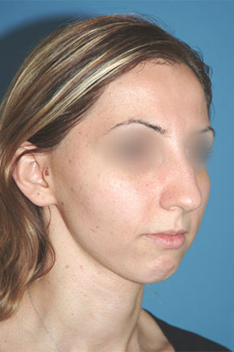 Rhinoplasty Before & After Gallery - Patient 810232 - Image 3