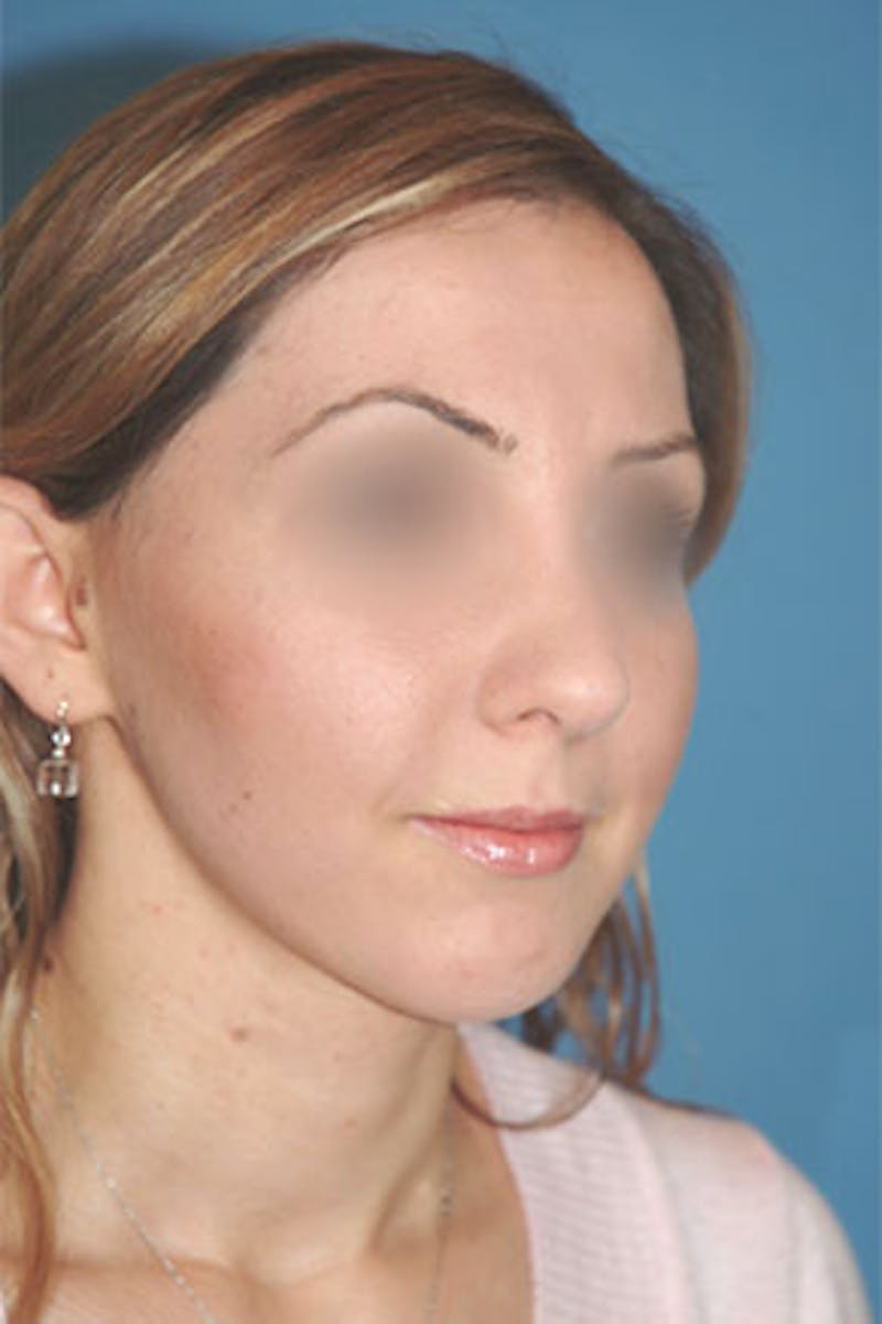 Rhinoplasty Before & After Gallery - Patient 810232 - Image 4
