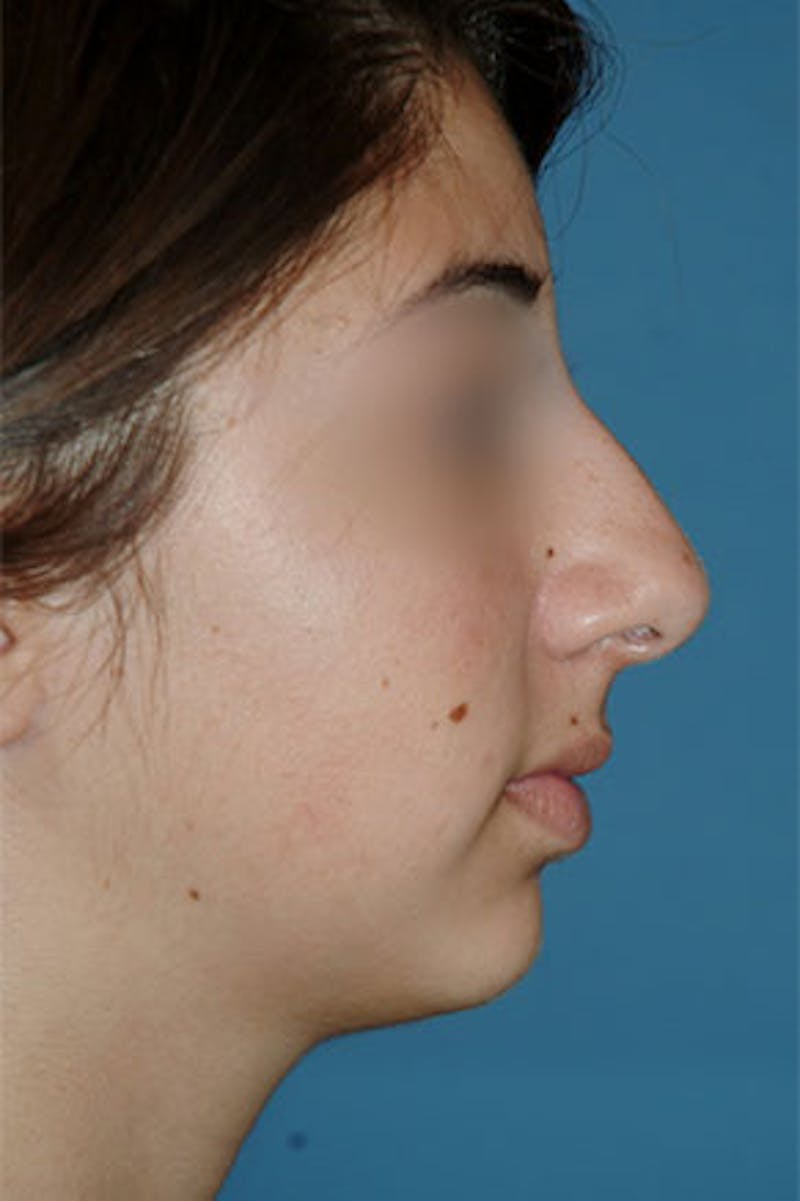 Rhinoplasty Before & After Gallery - Patient 826768 - Image 1