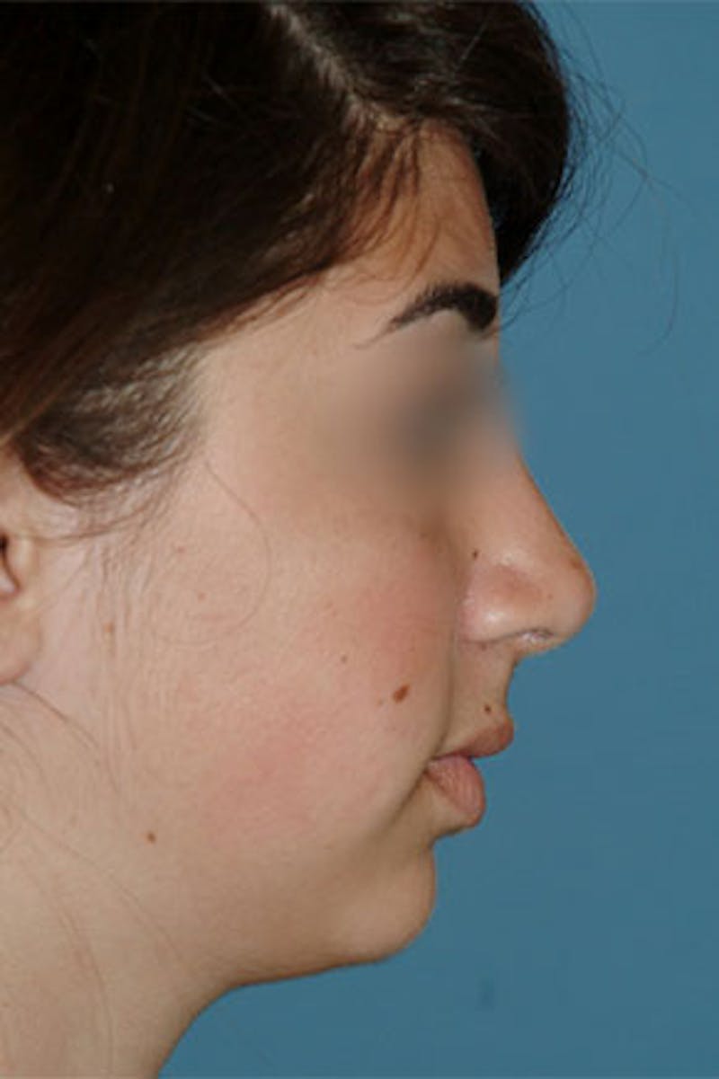 Rhinoplasty Before & After Gallery - Patient 826768 - Image 2