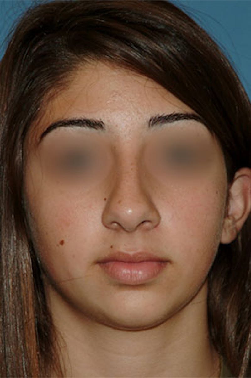 Rhinoplasty Before & After Gallery - Patient 826768 - Image 3