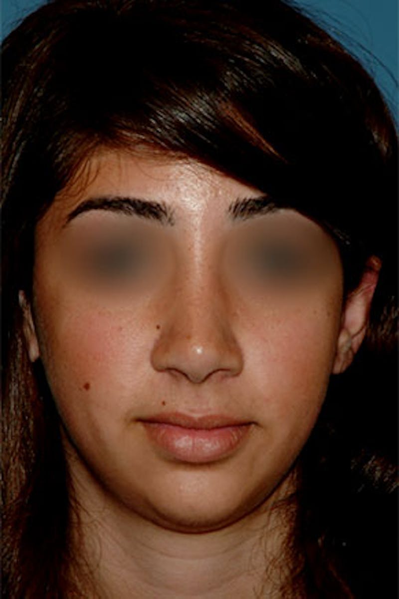Rhinoplasty Before & After Gallery - Patient 826768 - Image 4