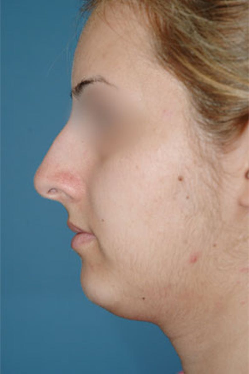 Rhinoplasty Before & After Gallery - Patient 295706 - Image 1