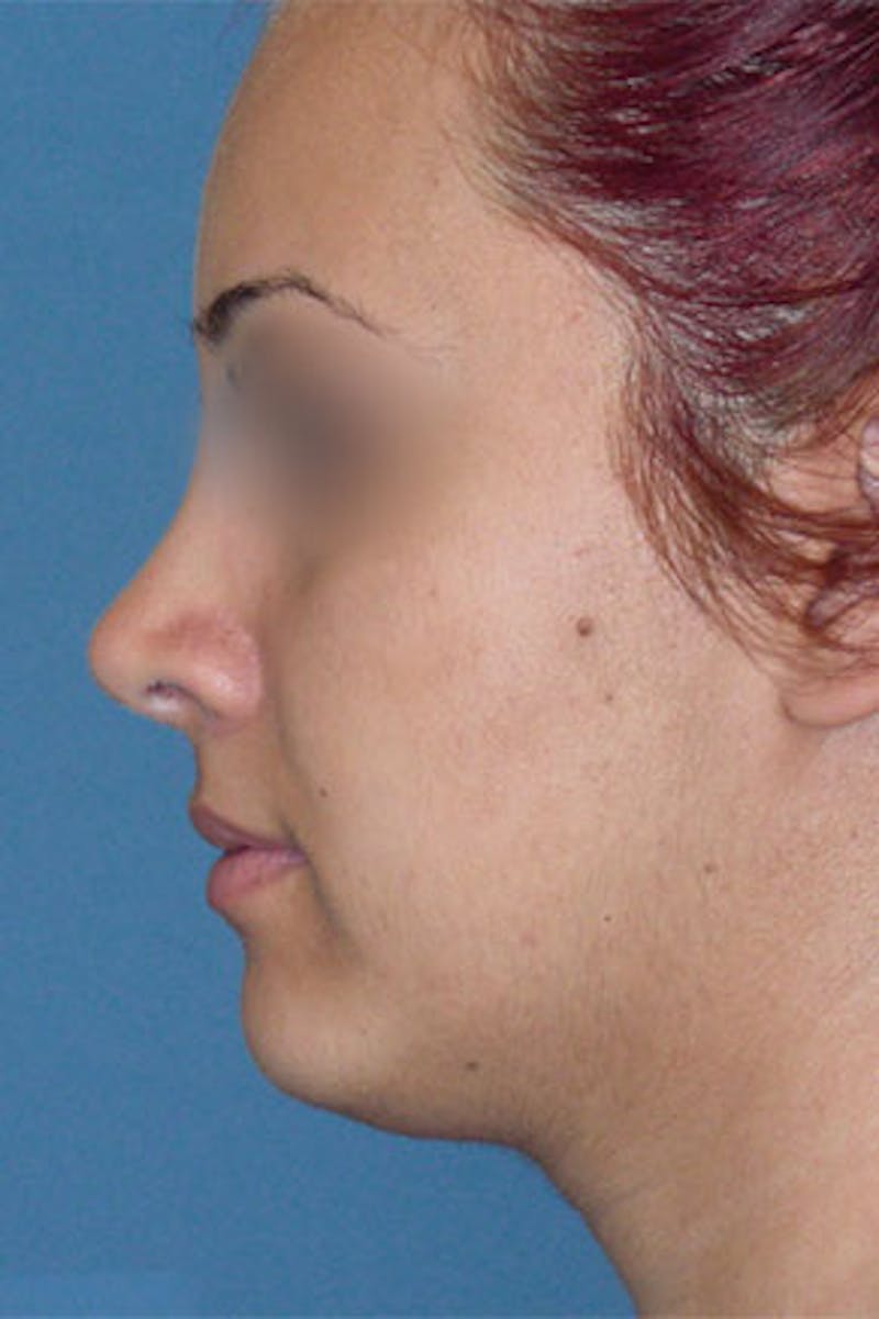 Rhinoplasty Before & After Gallery - Patient 295706 - Image 2