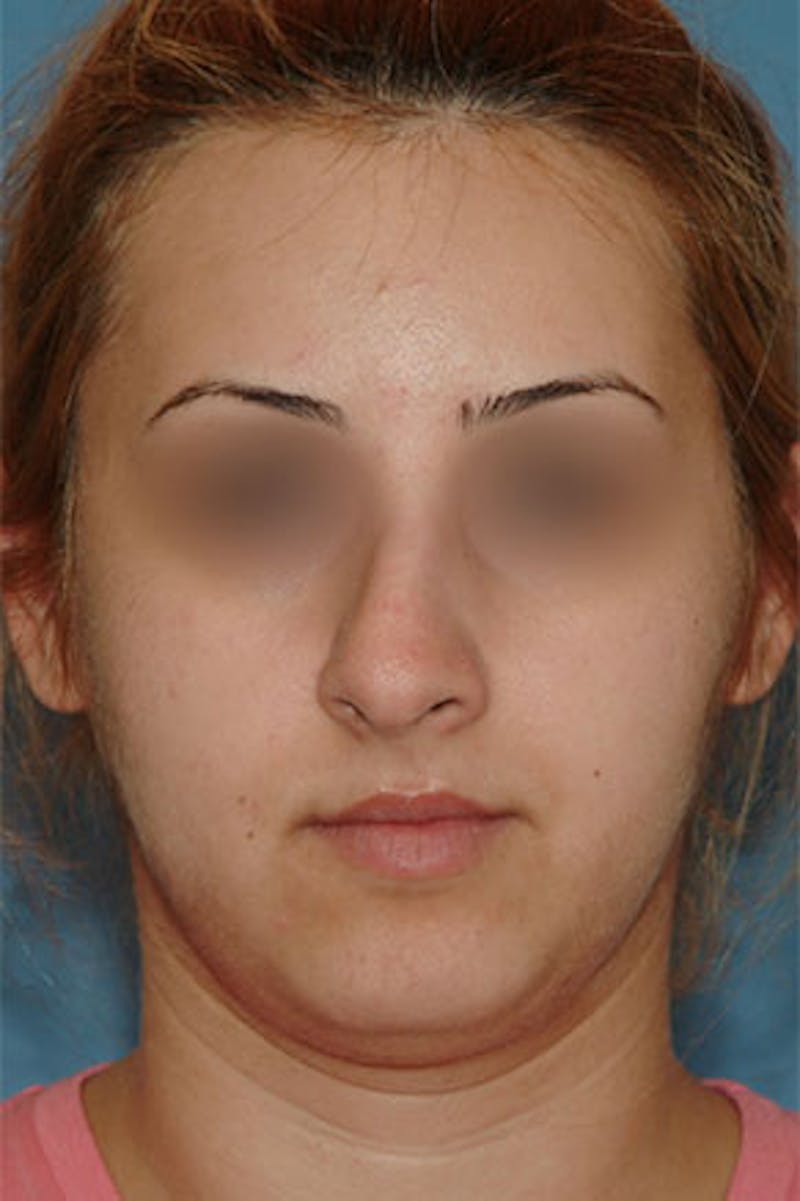 Rhinoplasty Before & After Gallery - Patient 295706 - Image 3