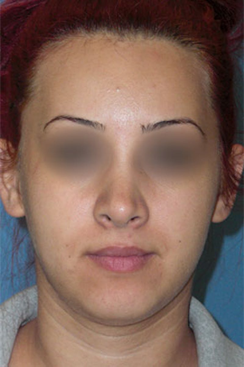 Rhinoplasty Before & After Gallery - Patient 295706 - Image 4