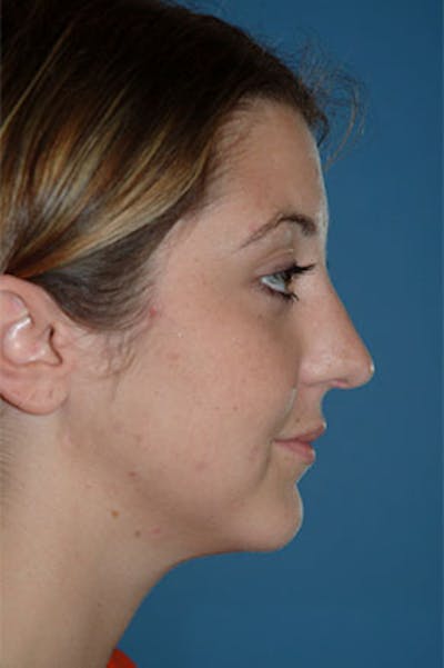 Rhinoplasty Before & After Gallery - Patient 325732 - Image 1