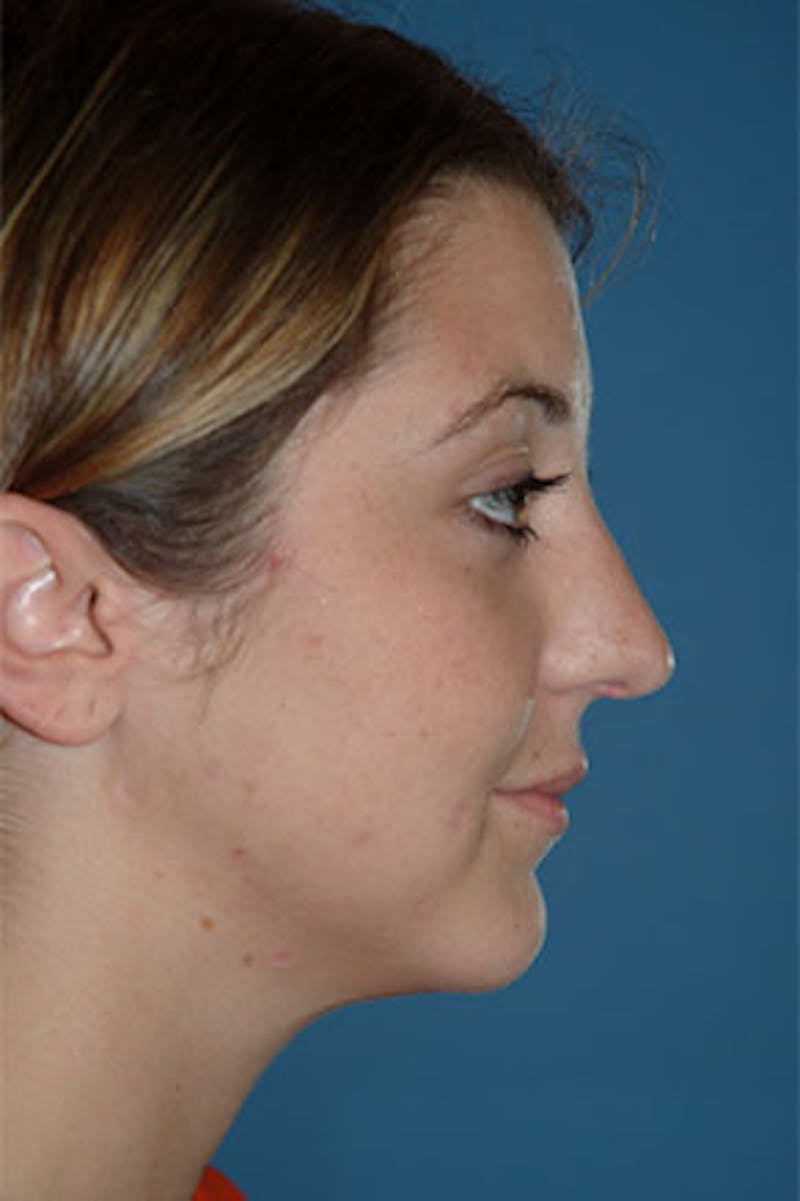 Rhinoplasty Before & After Gallery - Patient 325732 - Image 1