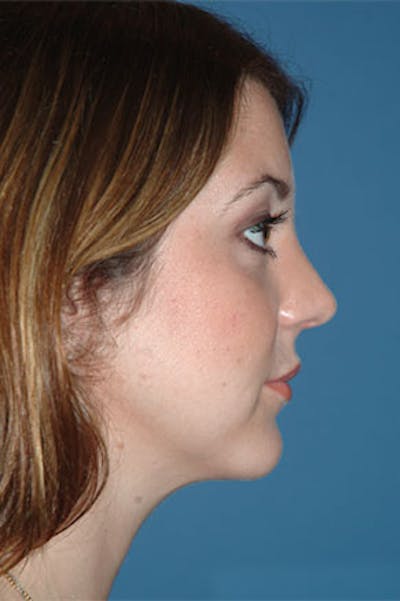 Rhinoplasty Before & After Gallery - Patient 325732 - Image 2