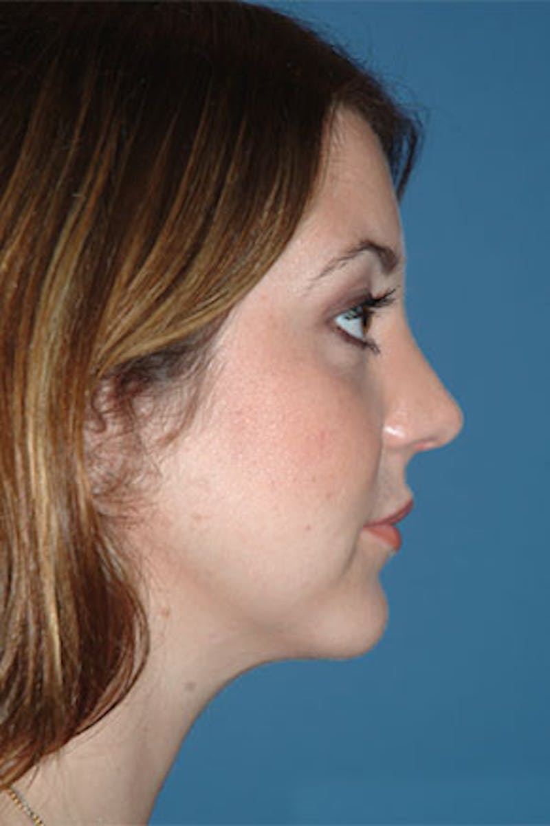 Rhinoplasty Before & After Gallery - Patient 325732 - Image 2