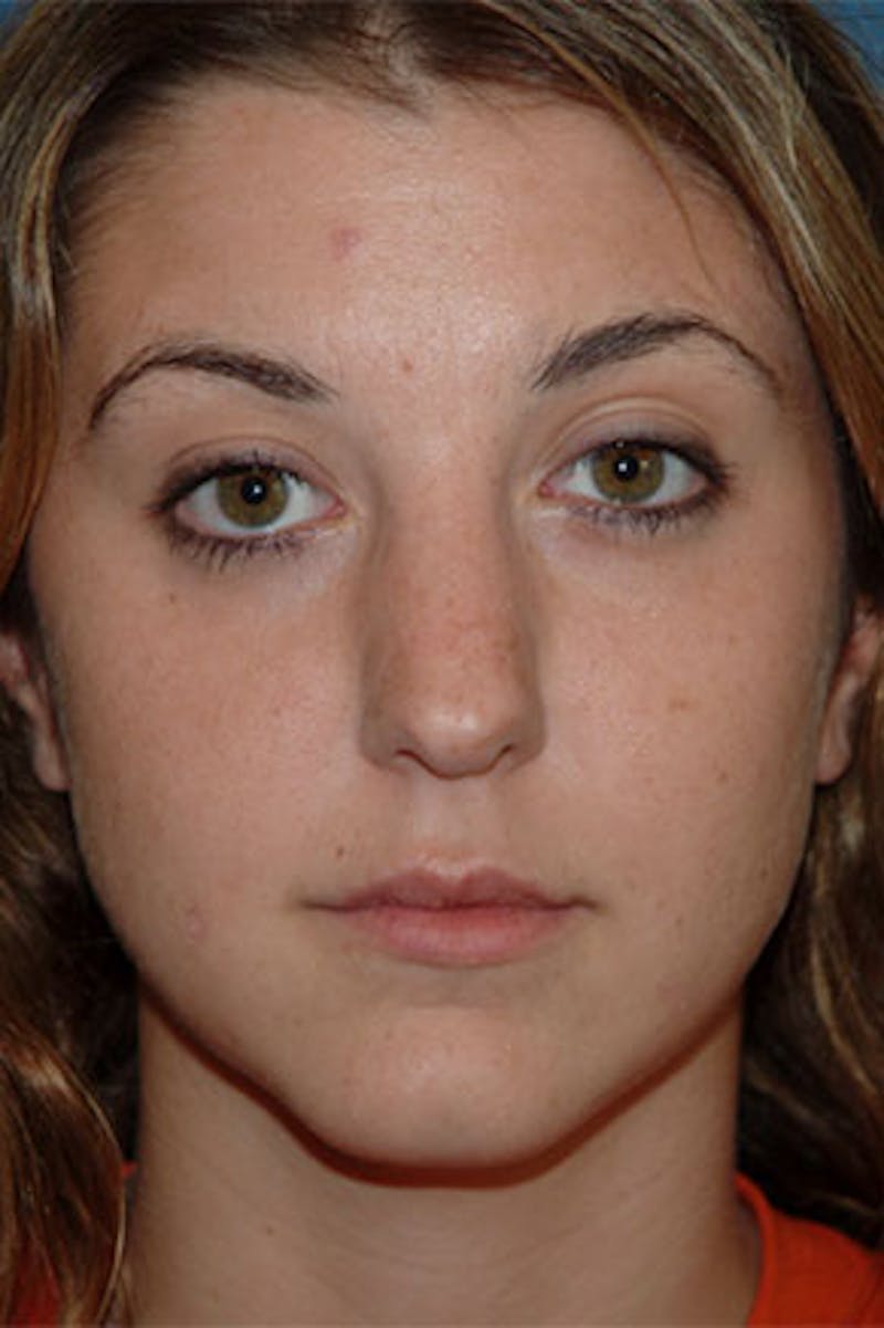 Rhinoplasty Before & After Gallery - Patient 325732 - Image 3