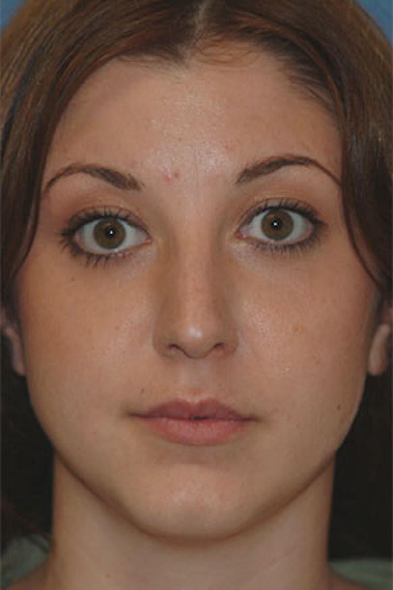 Rhinoplasty Before & After Gallery - Patient 325732 - Image 4
