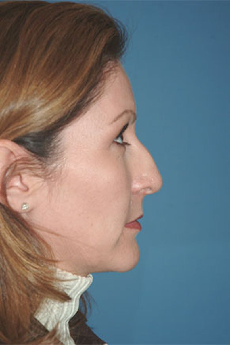 Rhinoplasty Before & After Gallery - Patient 211821 - Image 1