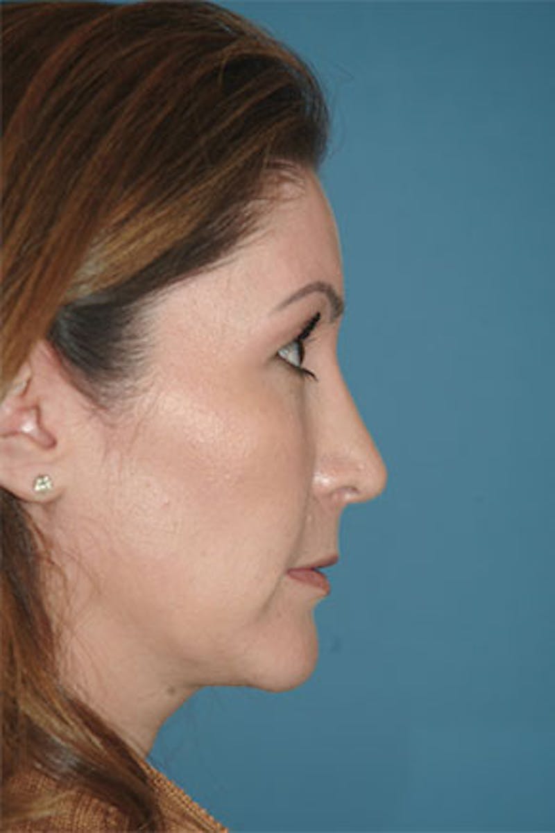 Rhinoplasty Before & After Gallery - Patient 211821 - Image 2
