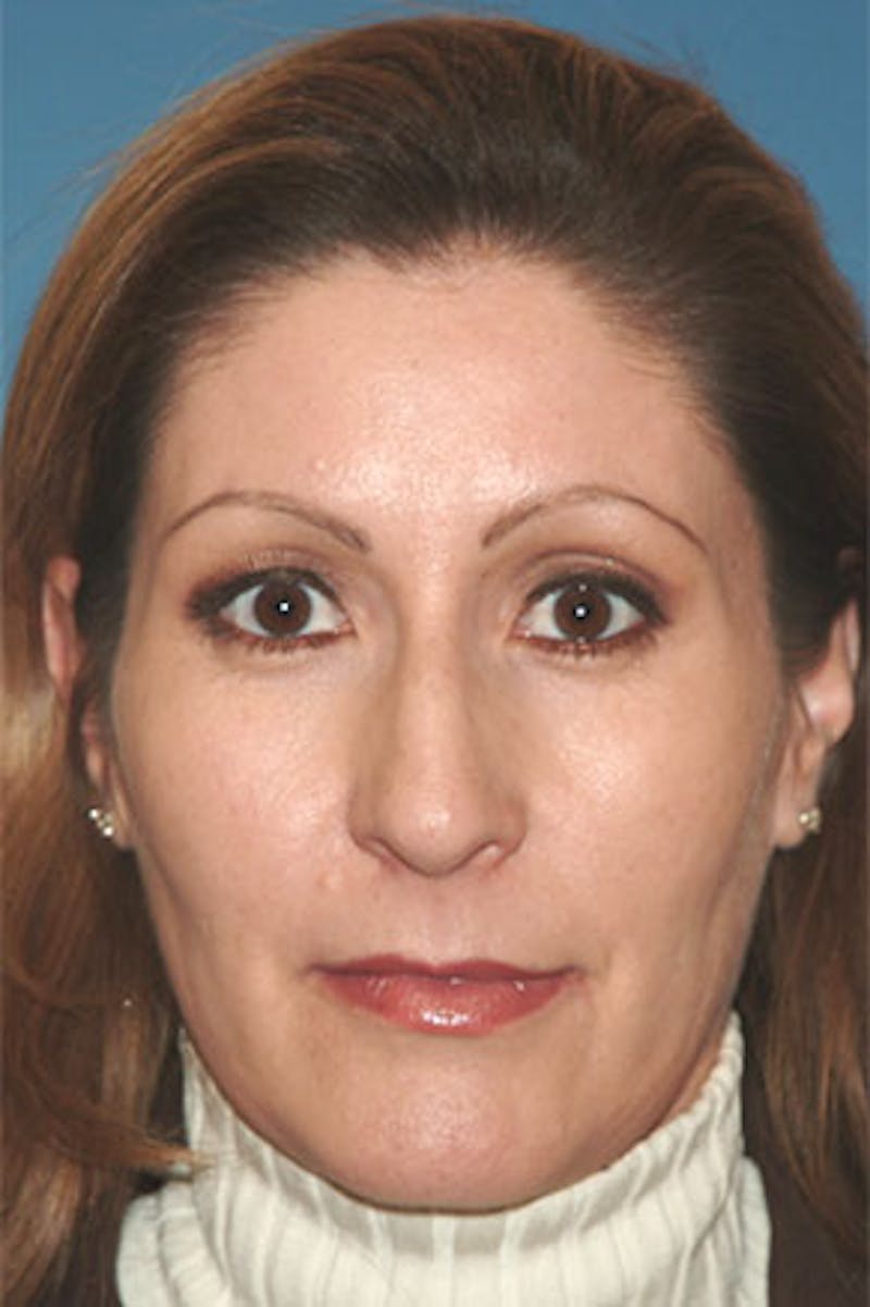 Rhinoplasty Before & After Gallery - Patient 211821 - Image 3