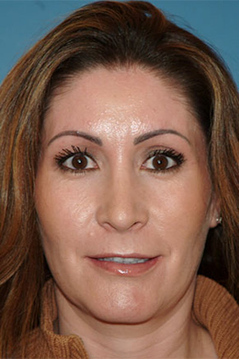 Rhinoplasty Before & After Gallery - Patient 211821 - Image 4