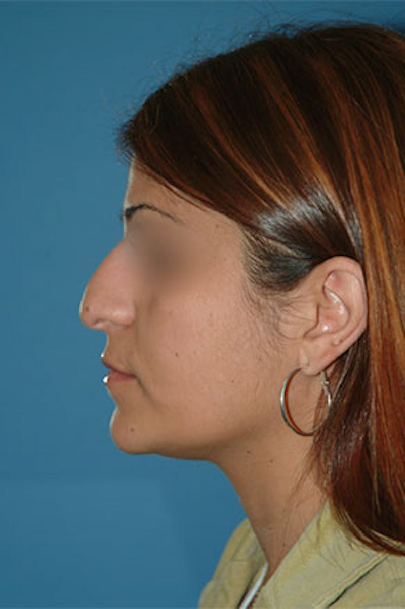 Rhinoplasty Before & After Gallery - Patient 131026 - Image 1