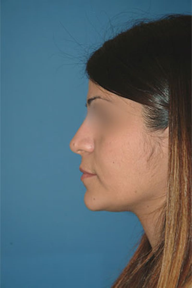 Rhinoplasty Before & After Gallery - Patient 131026 - Image 2