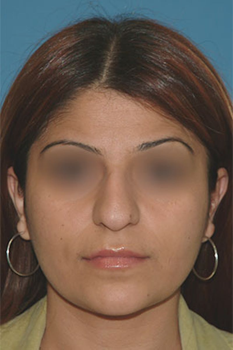 Rhinoplasty Before & After Gallery - Patient 131026 - Image 3