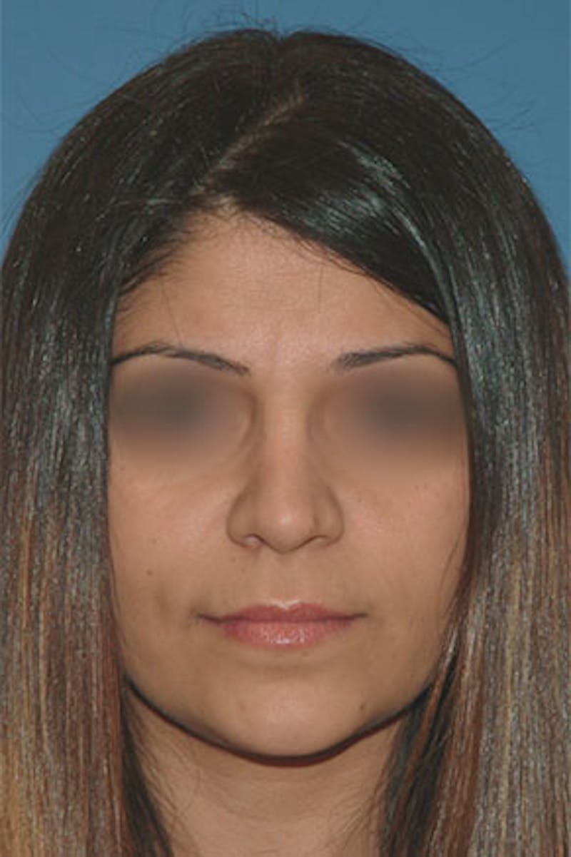 Rhinoplasty Before & After Gallery - Patient 131026 - Image 4