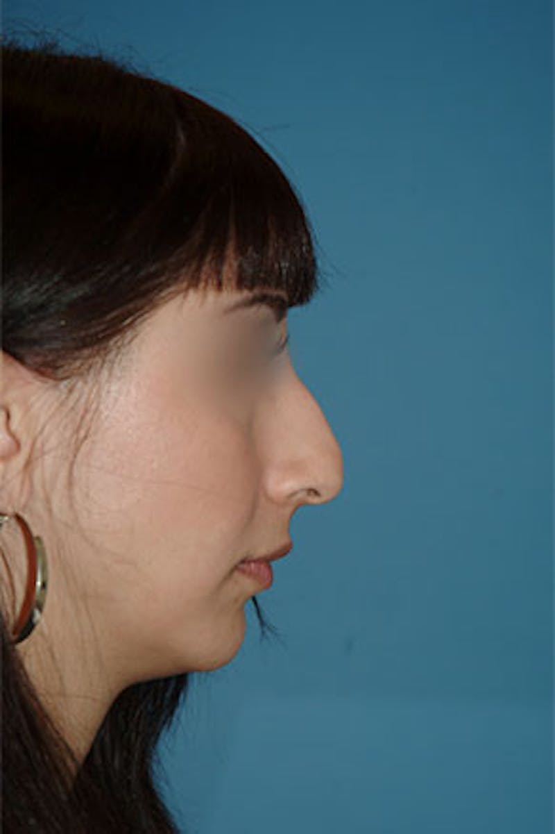 Rhinoplasty Before & After Gallery - Patient 576446 - Image 1