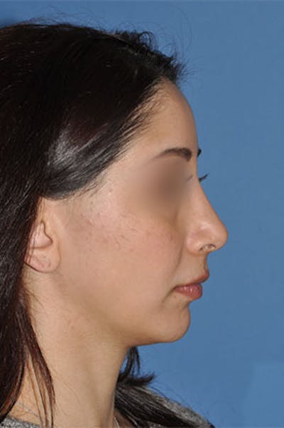 Rhinoplasty Before & After Gallery - Patient 576446 - Image 2