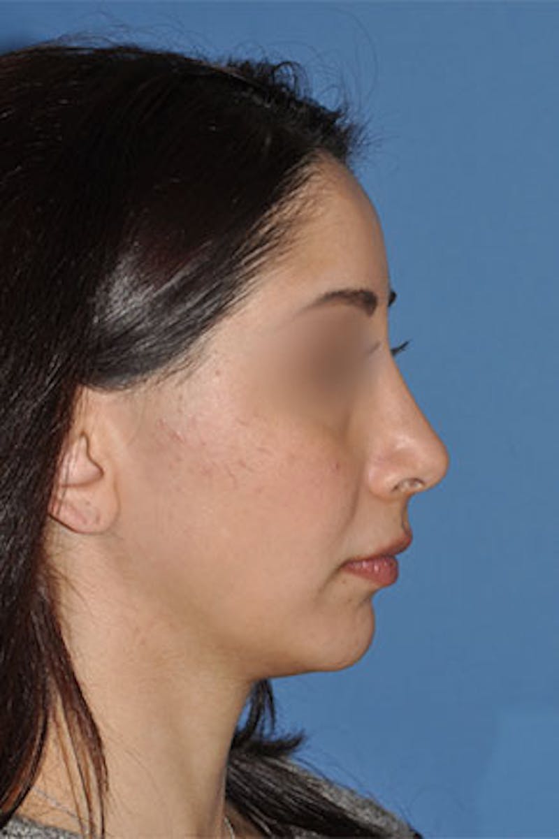 Rhinoplasty Before & After Gallery - Patient 576446 - Image 2