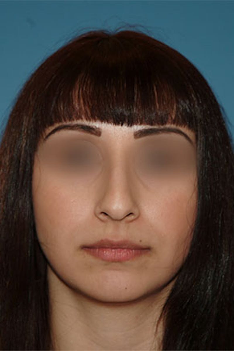 Rhinoplasty Before & After Gallery - Patient 576446 - Image 3
