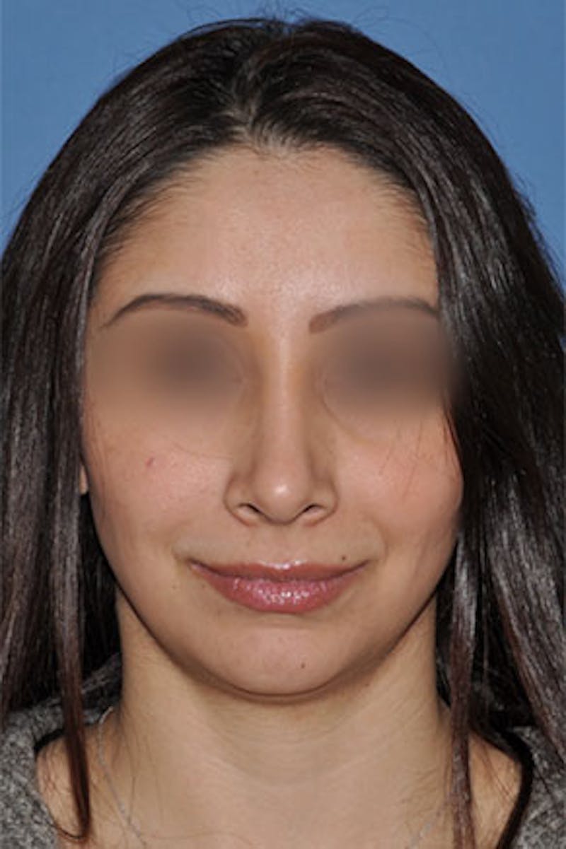 Rhinoplasty Before & After Gallery - Patient 576446 - Image 4
