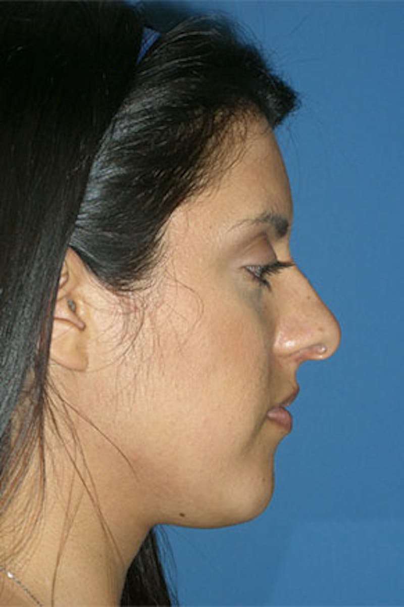 Rhinoplasty Before & After Gallery - Patient 281901 - Image 1