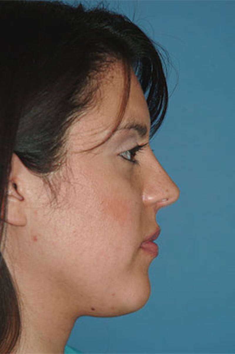 Rhinoplasty Before & After Gallery - Patient 281901 - Image 2