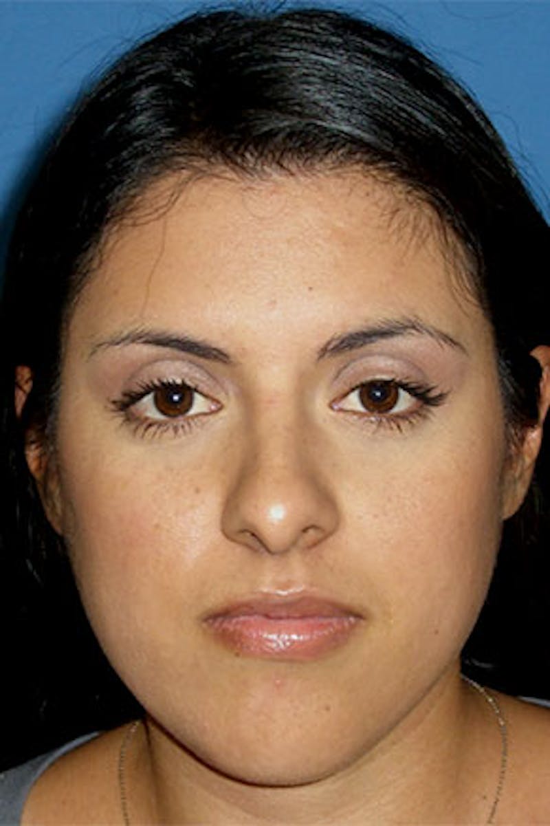 Rhinoplasty Before & After Gallery - Patient 281901 - Image 3
