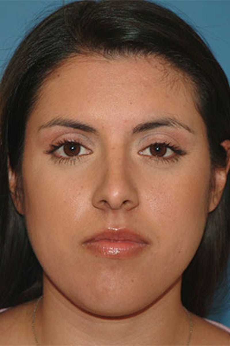 Rhinoplasty Before & After Gallery - Patient 281901 - Image 4
