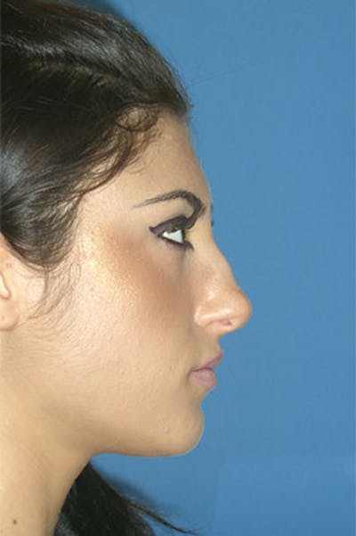 Rhinoplasty Before & After Gallery - Patient 289608 - Image 1