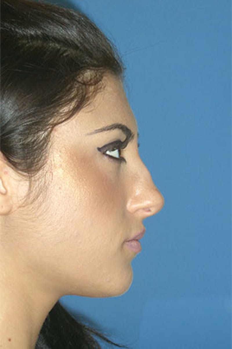 Rhinoplasty Before & After Gallery - Patient 289608 - Image 1