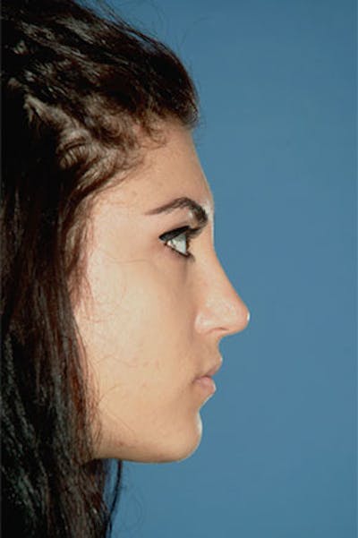 Rhinoplasty Before & After Gallery - Patient 289608 - Image 2