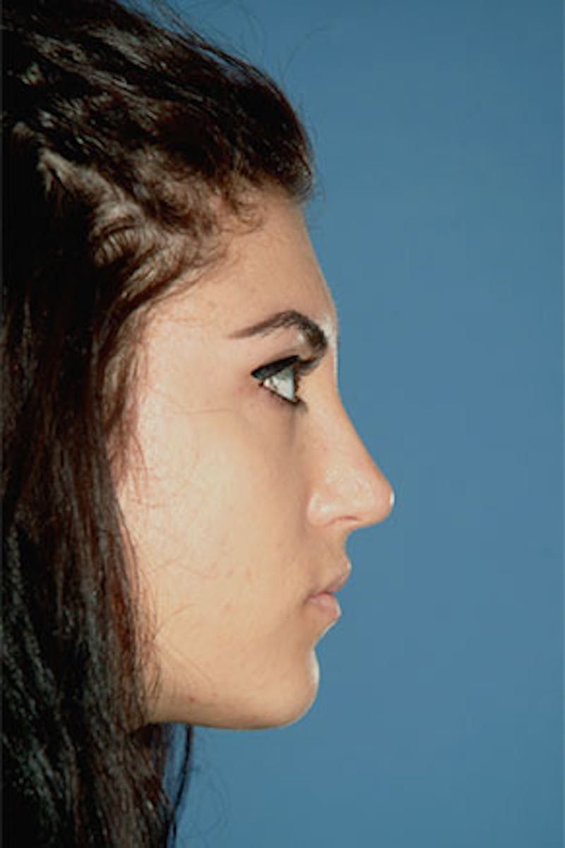 Rhinoplasty Before & After Gallery - Patient 289608 - Image 2