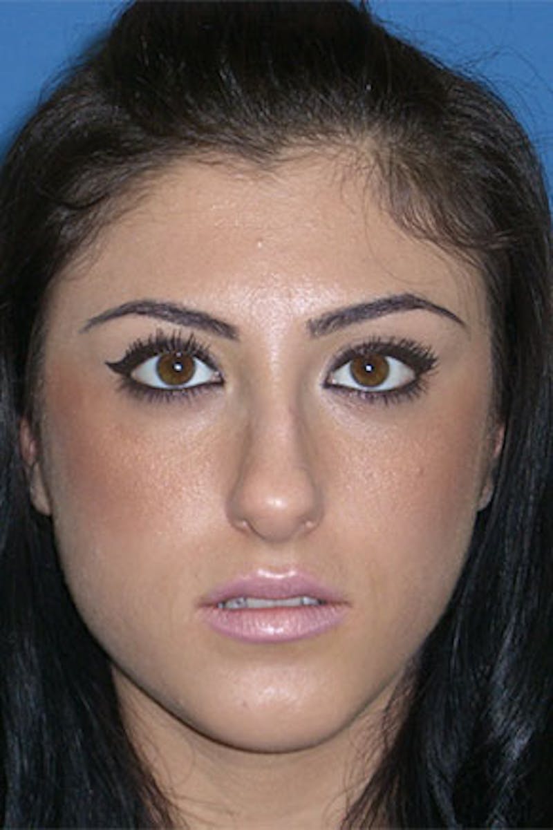 Rhinoplasty Before & After Gallery - Patient 289608 - Image 3