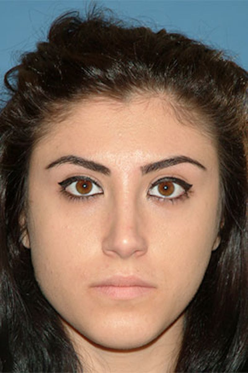 Rhinoplasty Before & After Gallery - Patient 289608 - Image 4