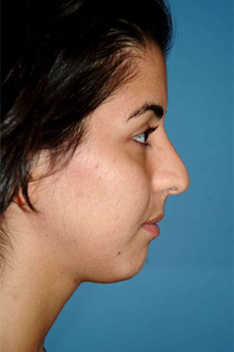 Rhinoplasty Before & After Gallery - Patient 130628 - Image 1