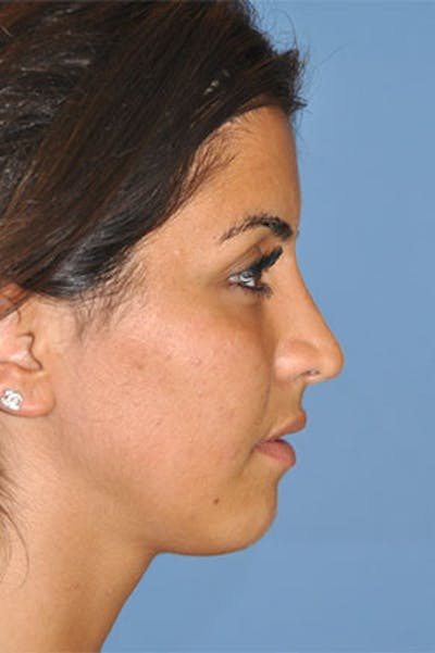 Rhinoplasty Before & After Gallery - Patient 130628 - Image 2