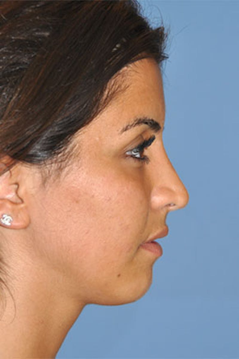 Rhinoplasty Before & After Gallery - Patient 130628 - Image 2
