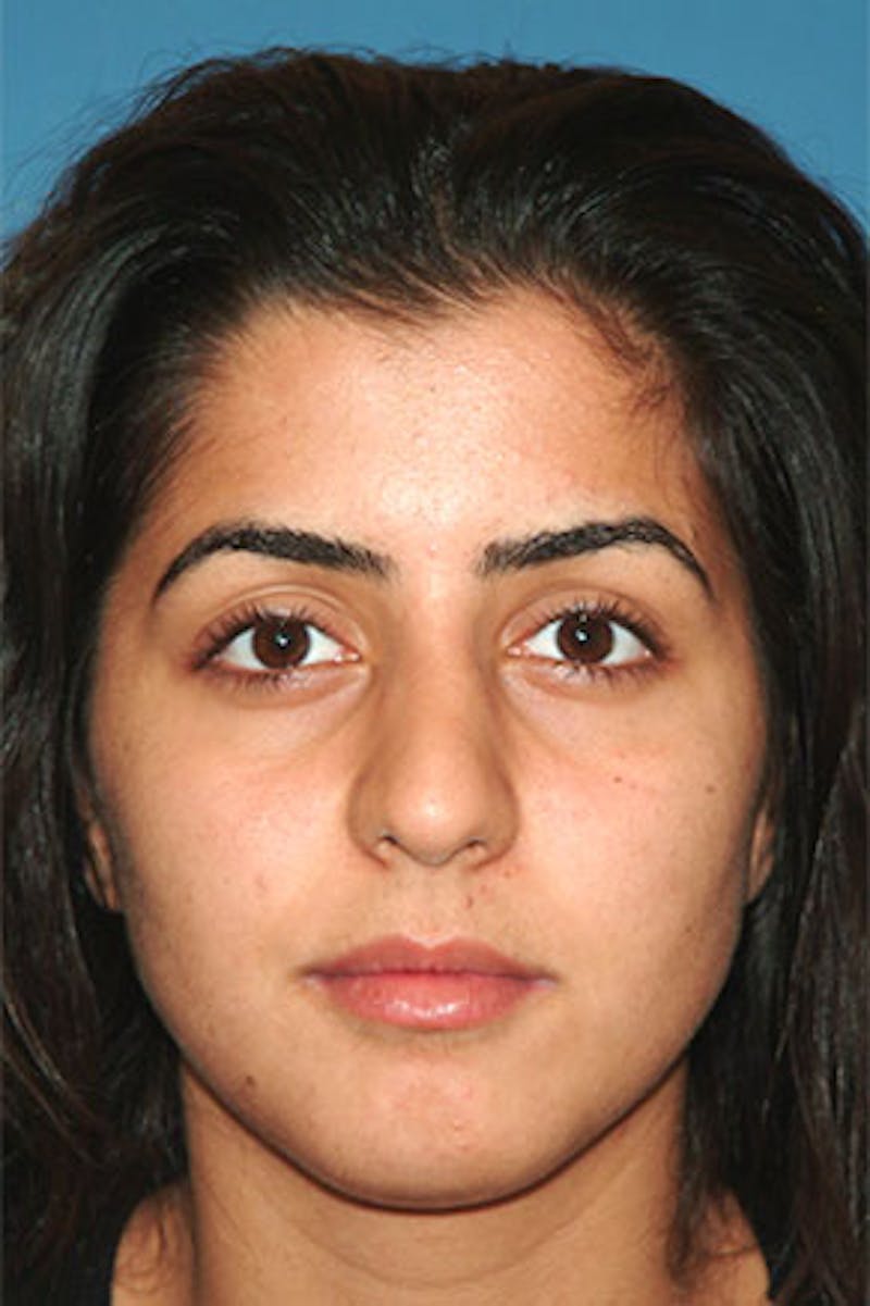 Rhinoplasty Before & After Gallery - Patient 130628 - Image 3