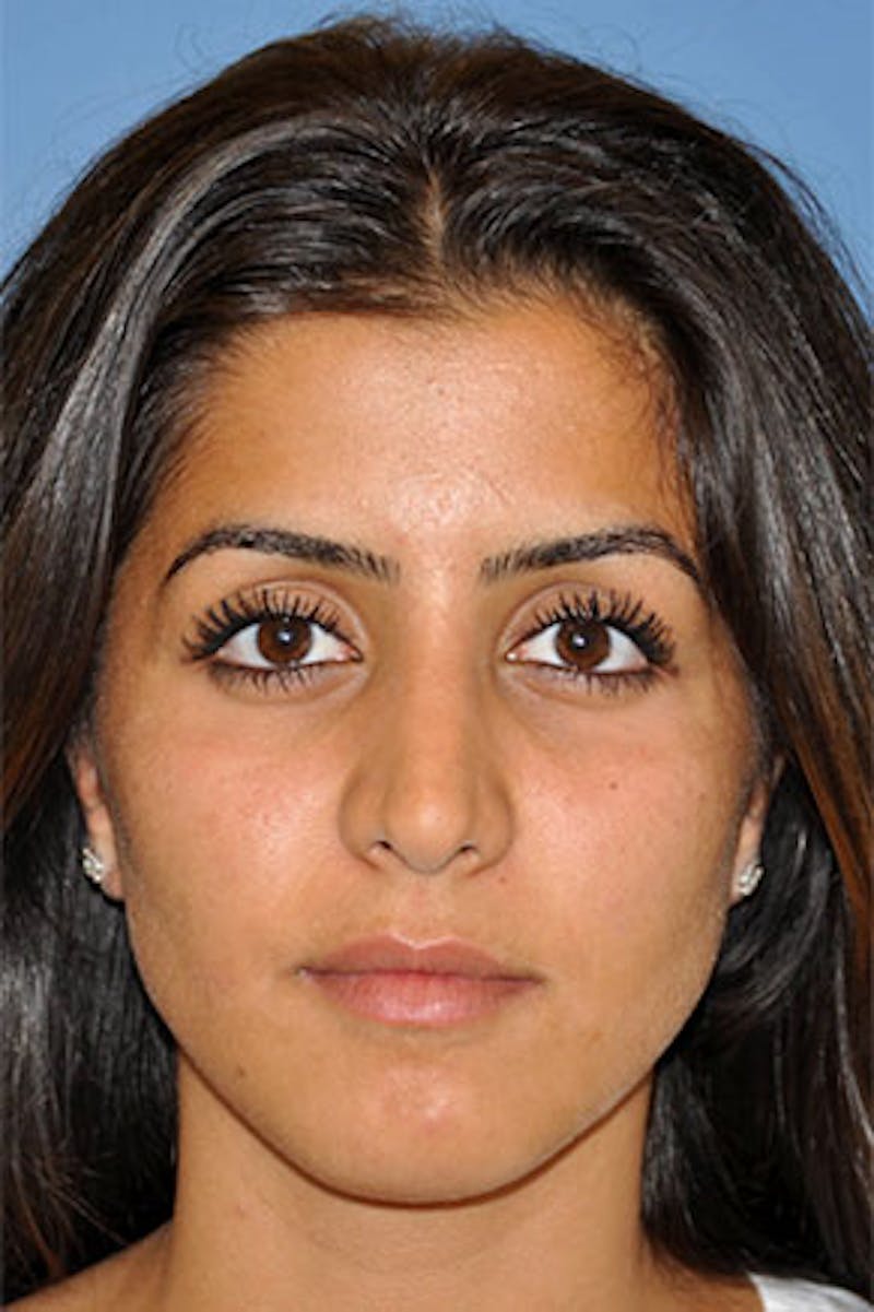 Rhinoplasty Before & After Gallery - Patient 130628 - Image 4