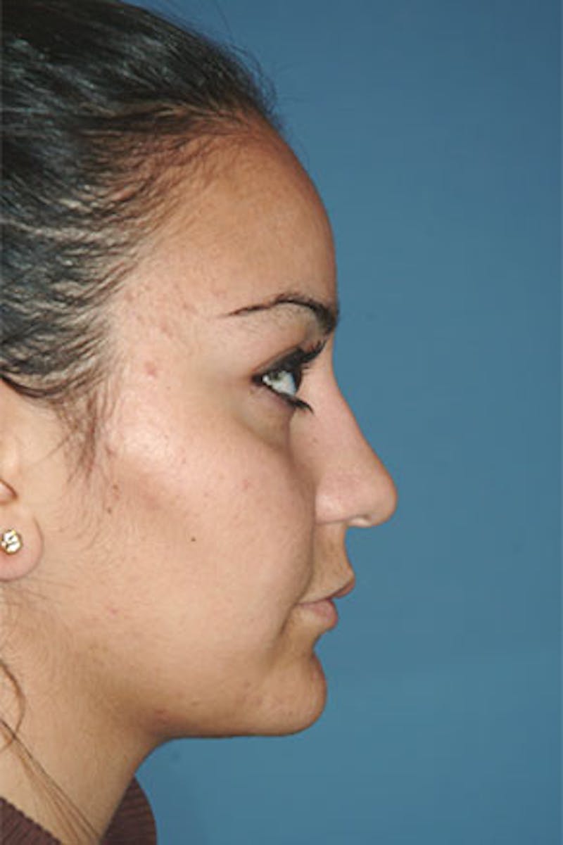 Rhinoplasty Before & After Gallery - Patient 326017 - Image 1