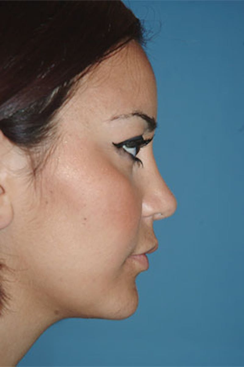 Rhinoplasty Before & After Gallery - Patient 326017 - Image 2