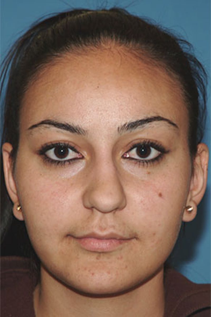 Rhinoplasty Before & After Gallery - Patient 326017 - Image 3