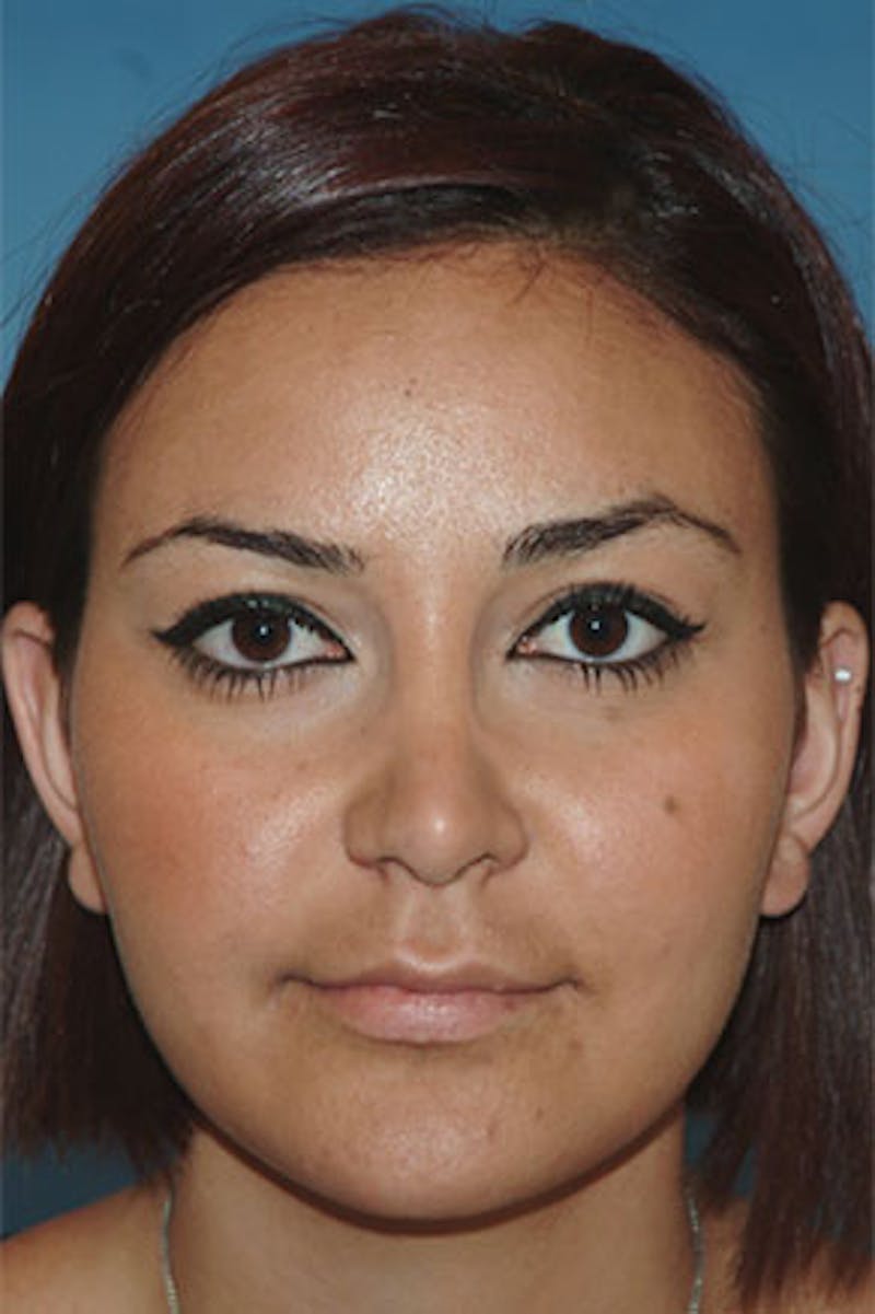 Rhinoplasty Before & After Gallery - Patient 326017 - Image 4